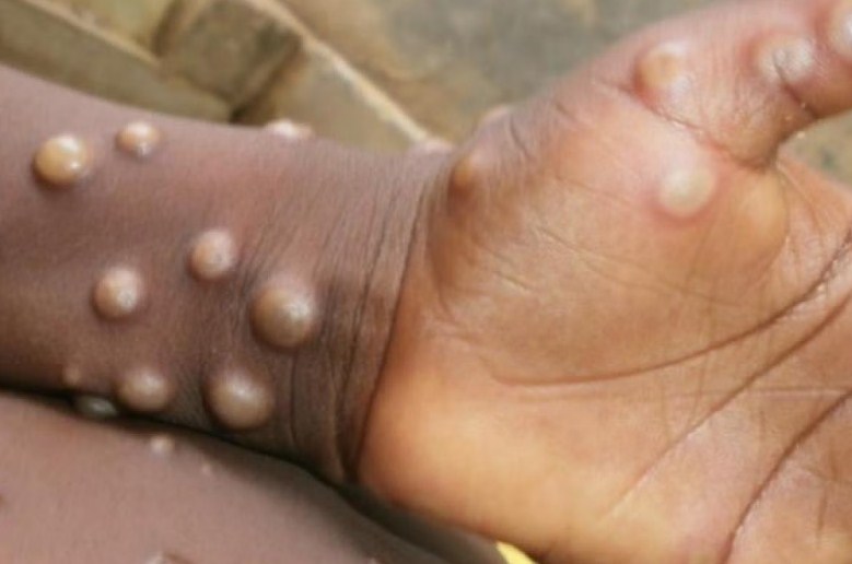 Monkey pox is a global epidemic
