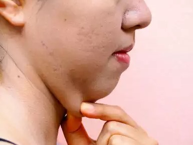How to get Rid of Neck Fat?