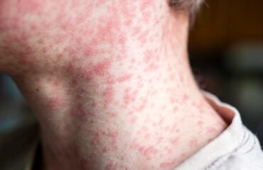 West Texas measles outbreak