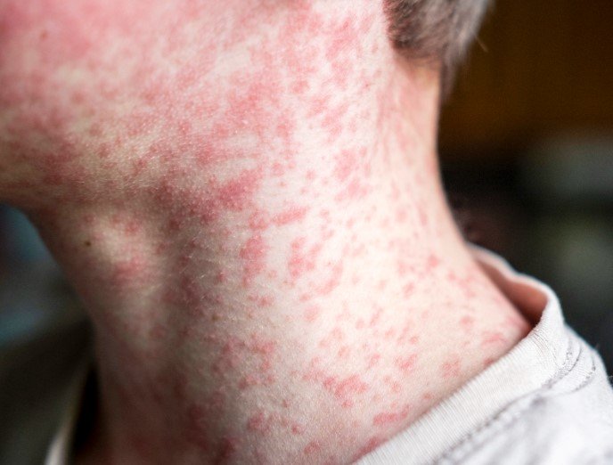 West Texas Measles Outbreak Surges to 58 Cases as Health Officials Scramble